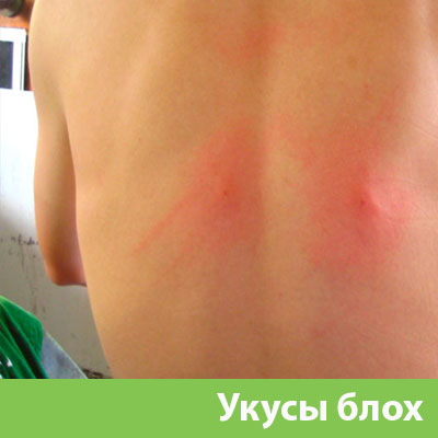 Укусы блох в Егорьевске
