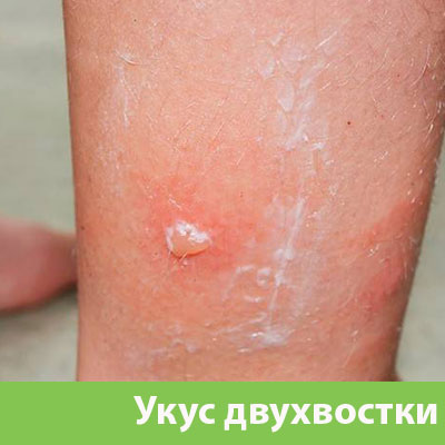 Укус двухвостки в Егорьевске