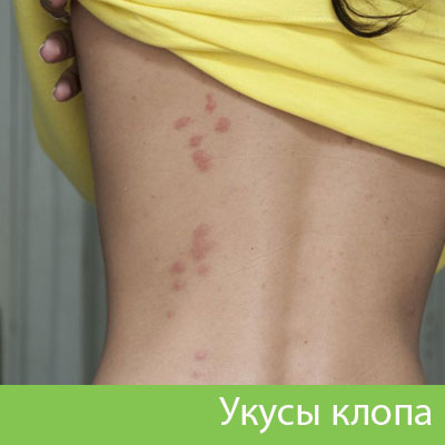 Профессиональное уничтожение клопов в Егорьевске